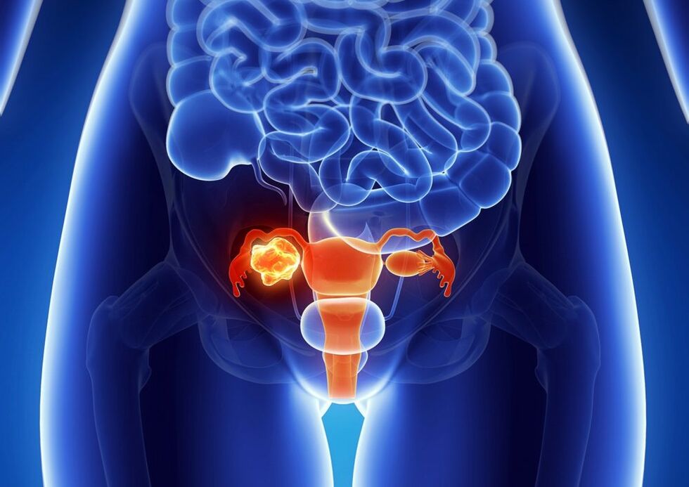 Pathologie ovil de la femme sous l'influence de l'alcool
